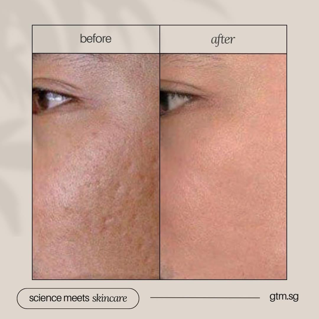 PDRN Healer Set- Free DEP Mela Cell Treatment worth $450