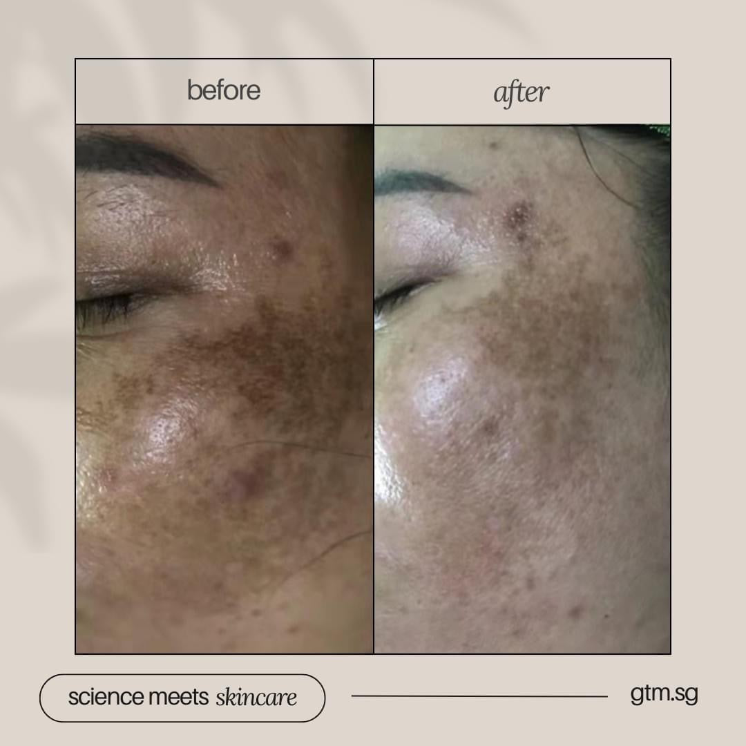 Whitening Set- Free DEP Mela Cell Treatment worth $450
